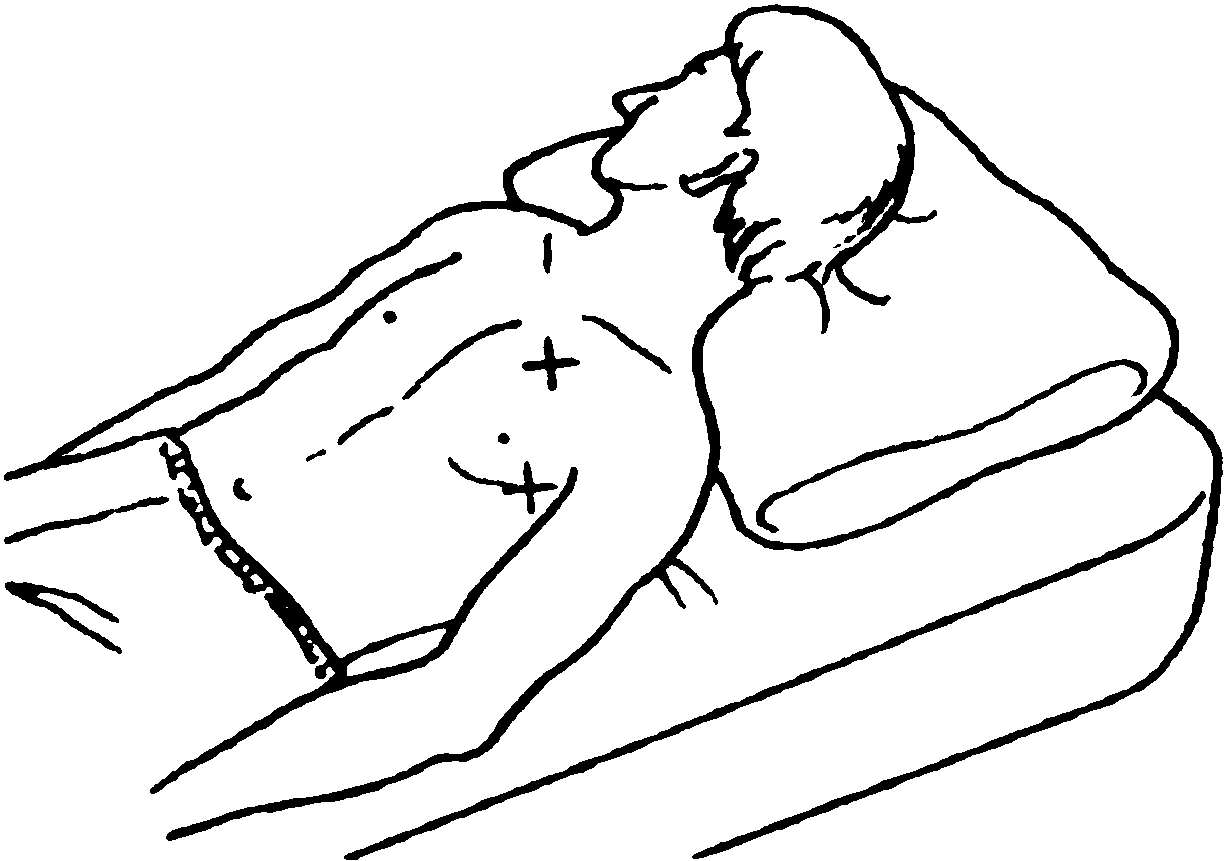 三、胸腔閉式引流術(shù)